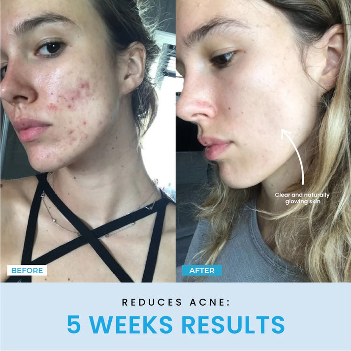 V-Sculpt™ – Redefine Your Jawline in Just 5 Minutes a Day